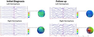 Mean global field power is reduced in infantile epileptic spasms syndrome after response to vigabatrin